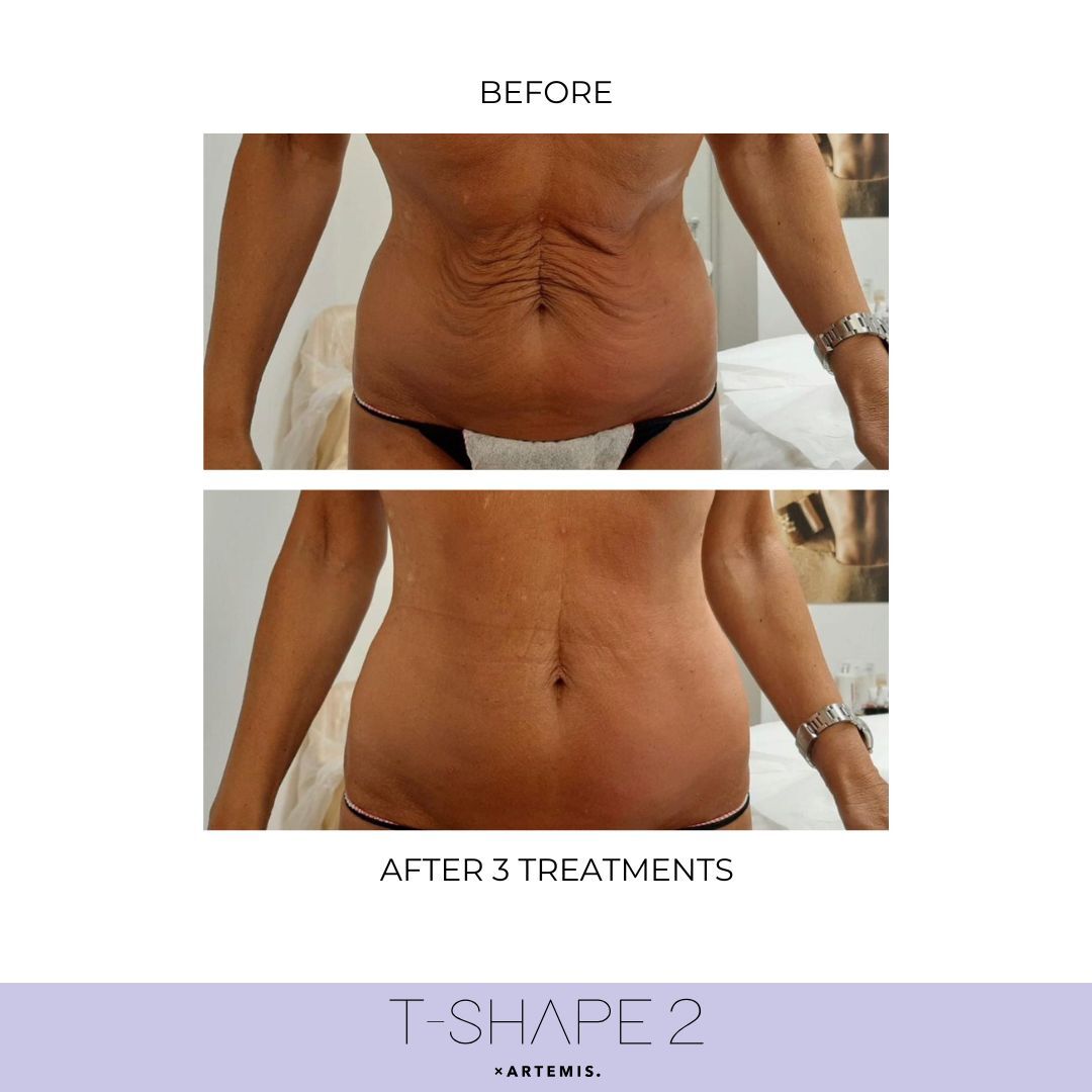 Abdomen before and after results at iCRYO Branford