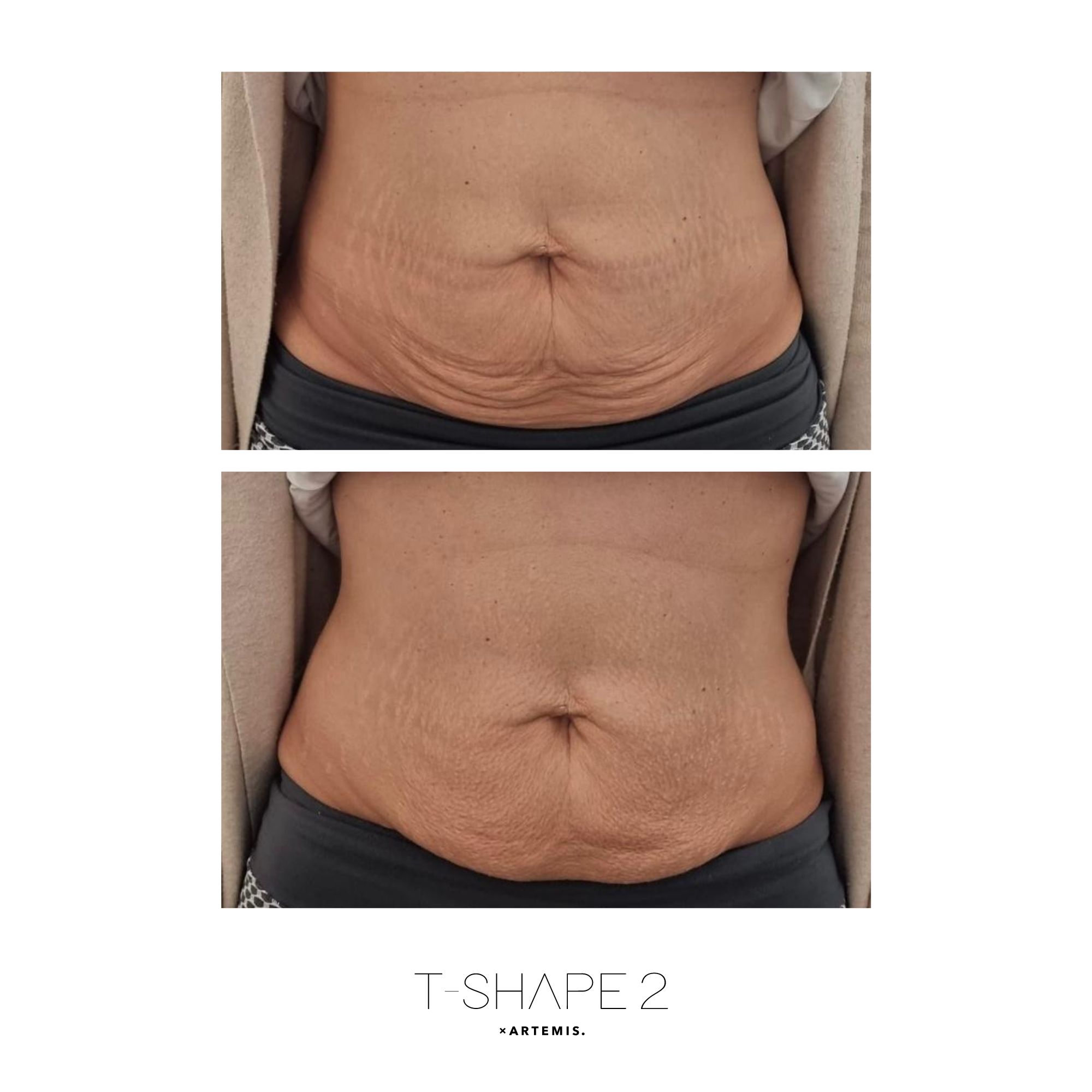 Abs before and after results at iCRYO Branford