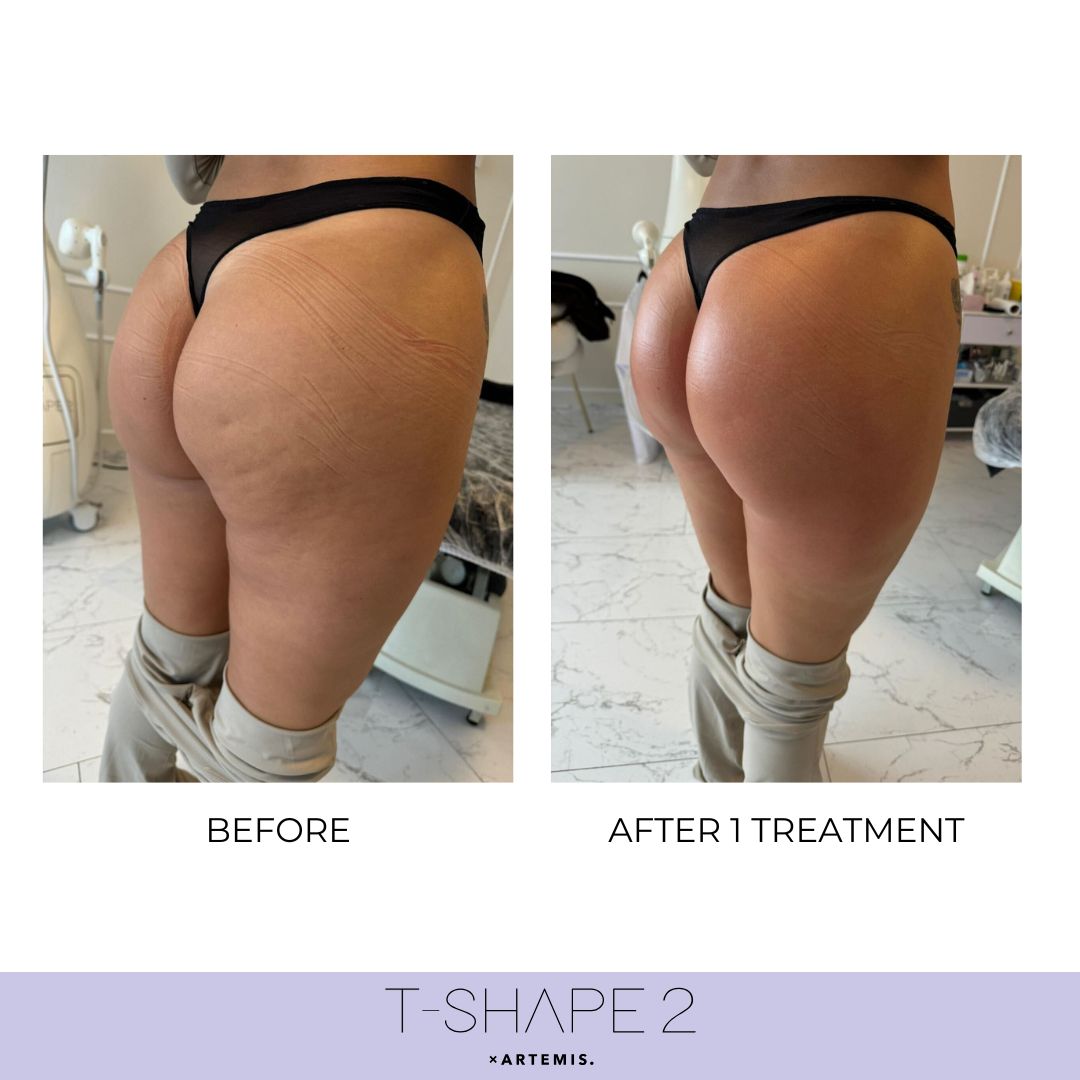 Body before and after results at iCRYO Branford