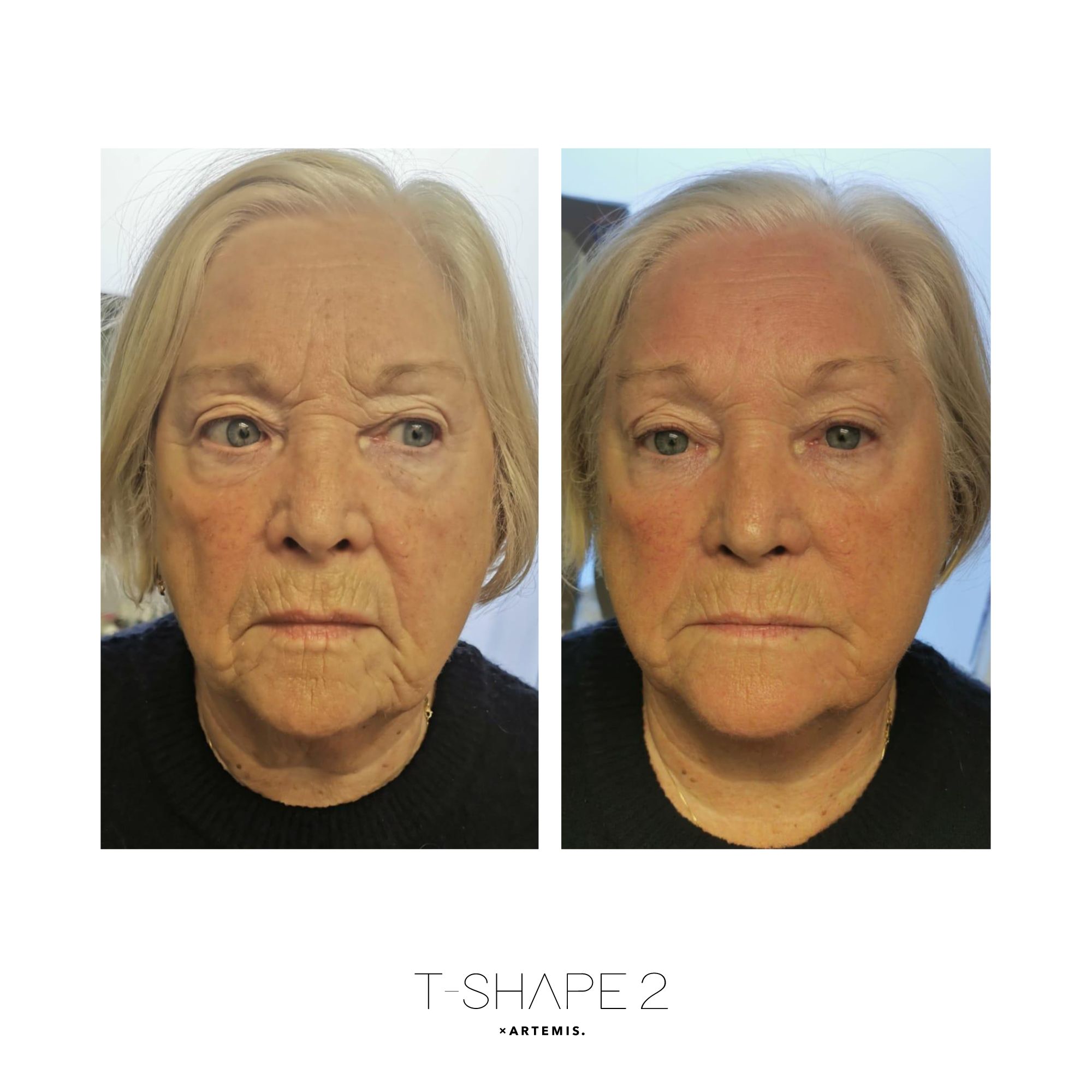 Face before and after results at iCRYO Branford