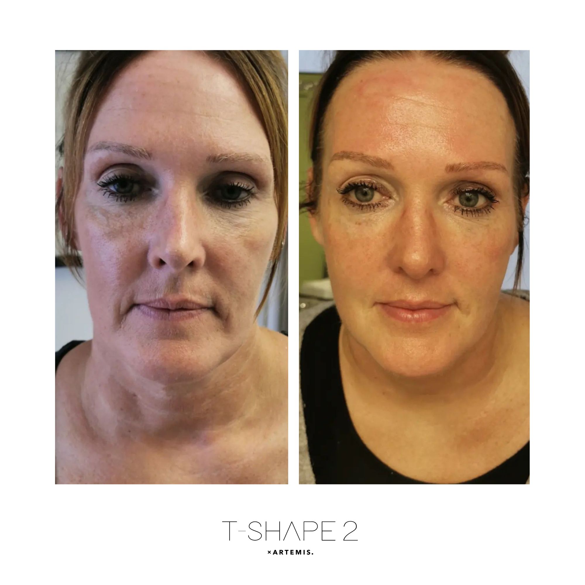 Face before and after results at iCRYO Branford