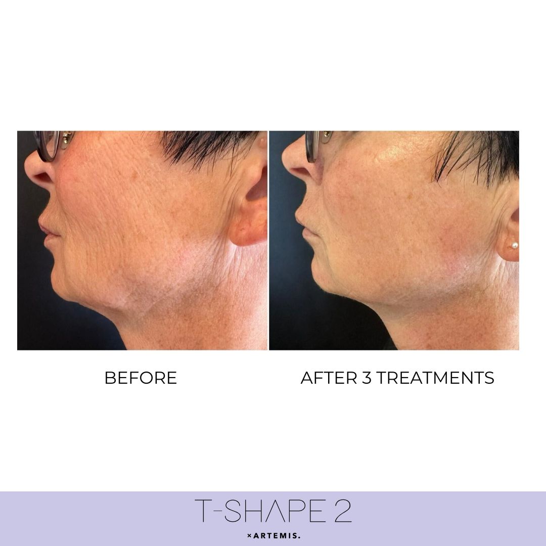 Neck before and after results at iCRYO Branford